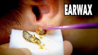 THE BEST EARWAX REMOVAL EVER and most gross  Dr Paul [upl. by Hephzibah]