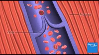 How deep vein thrombosis DVT forms  Bupa Health [upl. by Sarene]