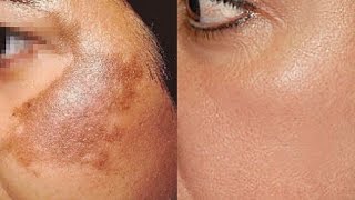 How To Use Potato To Treat Skin Pigmentation Dark Spots Acne Scars Easily At Home  Home Remedies [upl. by Aisyle]