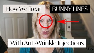 How To Treat Bunny Lines Wrinkles 🐰 with AntiWrinkle Injections [upl. by Colyer]