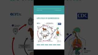 Case of Hydatid Liver Cyst medicaladvancements doctor neet surgicalinnovation usmle [upl. by Ramej]