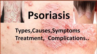 Psoriasis  Types Causes Symptoms Treatment Complications  Types of Psoriasis [upl. by Nirrol402]