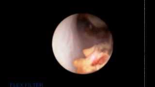 Ureteroscopy and laser fragmentation of stone [upl. by Singh576]