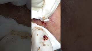 Big Cystic Acne Blackheads Extraction Blackheads amp Milia Whiteheads Removal Pimple Popping shorts [upl. by Linnie316]