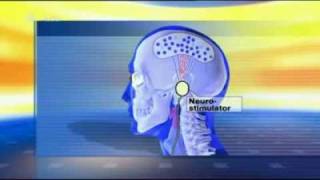 Tinnitus  Therapie durch Neurostimulation 1 [upl. by Anwahsit350]