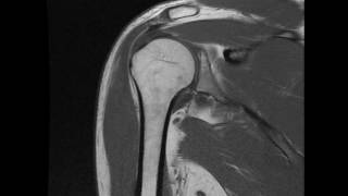 Partial thickness supraspinatus tear  cor T1 [upl. by Ylim869]