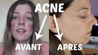 ACNE  Mon expérience et traitements naturels [upl. by Acceber180]