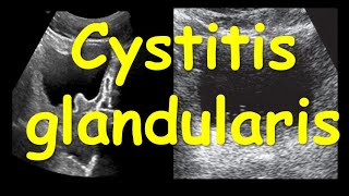 Cystitis glandularis [upl. by Cheng492]