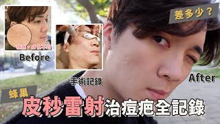 痘斑、痘疤全治好？醫美真的能讓皮膚變好？皮秒雷射全記錄｜米鹿deerdeer [upl. by Smaj]