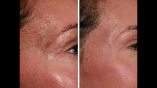 mini face lift before and afterfacelift massage at homeliquid faceliftfacial rejuvenation [upl. by Aihtiekal239]