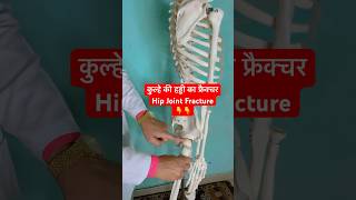 कुल्हे की हड्डी का फ्रैक्चर  Hip Joint Fracture  Femur Bone shorts viral youtubeshorts [upl. by Vinnie259]