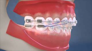 Class II Elastics  Lateral View HD Edition [upl. by Annet]