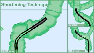 COLONOSCOPY Segment by Segment 2203 [upl. by Tanny]