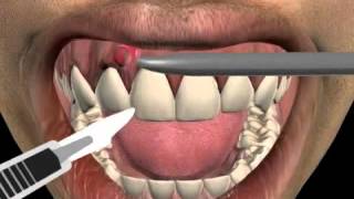 How to treat a tooth abscess [upl. by Anavlys]