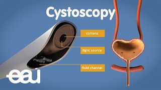 Cystoscopy overactive bladder [upl. by Ariamat]