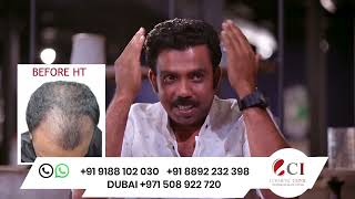 Hair Transplantation done by Malayalam Cine artist Azees Nedumangad [upl. by Craw]