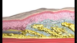 Liposuction Animation [upl. by Maida]