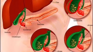 GASTROENTEROLOGIE  angiocholite pancréatite aigue cholécystite aigue colique hépatique [upl. by Stephi]