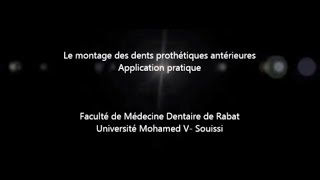 Montage des dents prothétiques antérieures [upl. by Mohandis]