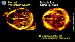 Spina bifida 3D ultrasound diagnosis at 1113 weeks [upl. by Eelrebmyk]