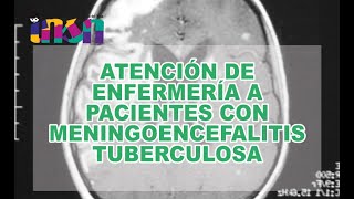 Atención de Enfermería a Pacientes con Meningoencefalitis Tuberculosa [upl. by Anna-Maria59]