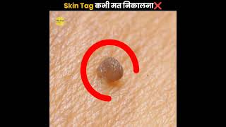 Skin Tag कभी मत निकालना ❌  Never Remove Skin Tag  The Fact  shorts ytshorts [upl. by Jelle]