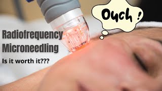 Radiofrequency Microneedling  Does it actually work  Dermatologist reviews [upl. by Selassie]