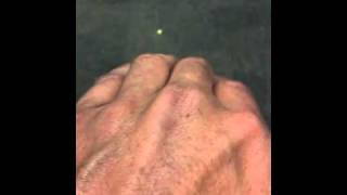 Tendon sheath rupture in middle finger knuckle [upl. by Meadows]