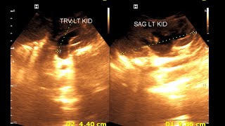 Bilateral hydro nephrosis  Bilateral dilated ureter  Renal Ultrasonography [upl. by Dowlen]