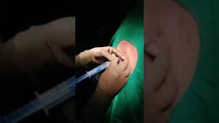 Epidural Catheter Insertion technique [upl. by Eltotsira354]