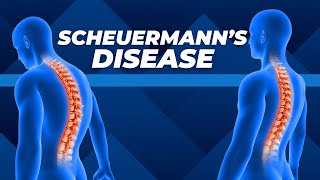 Top Three Exercises for Scheuermanns Disease [upl. by Petromilli]