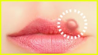 10 Naturheilmittel gegen Lippenherpes [upl. by Ardnalac]