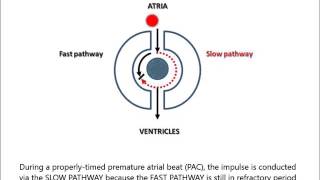 AV Nodal Reentry Tachycardia AVNRT for noncardiologist in less than 2 minutes [upl. by Tawnya]