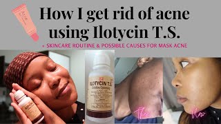 How I treat acne and acne scars using Ilotycin TS SKINCARE ROUTINE South African YouTuber [upl. by Jordon]