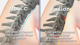 Mobi C vs fusion movement in neck [upl. by Areema]