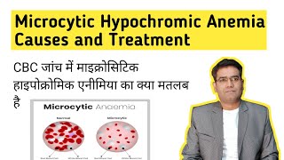 What is Microcytic Hypochromic Anemia its Causes and Treatment in Hindi Iron Deficiency [upl. by Nagram895]