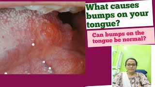 Tongue bumpsCan bumps on the tongue be normalWhat causes papillitis on tonguewhat to do for cure [upl. by Aiuqal]