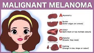 Malignant melanoma Signs Pathophysiology Types Diagnosis Treatment [upl. by Tufts155]