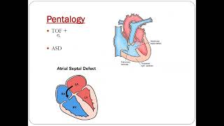 Pentalogy of fallot  Dr Akif Baig [upl. by Osber]