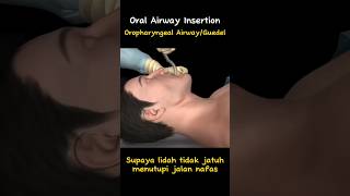 Oropharyngeal Airway [upl. by Namus767]