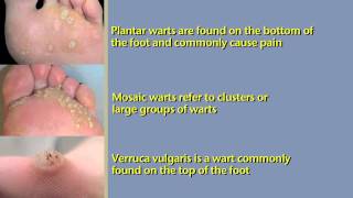 What are Foot Warts and How To Treat Them [upl. by Lanae]