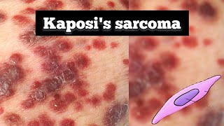 Kaposis sarcoma pathology  Kaposis sarcoma lecture  Quick revision  tarangacademy7561 [upl. by Eelrahc]