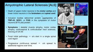 Amyotrophic Lateral Sclerosis ALS  Basics amp Clinical Presentation [upl. by Anaud]