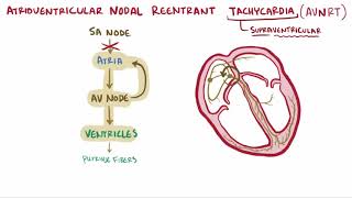 Atrioventricular reentrant tachycardia AVRT amp nodal reentrant tachycardia AVNRT [upl. by Herrington533]