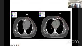 Dr V Ravi Shankar  Adjuvant Radiotherapy in Breast Cancer [upl. by Fitzsimmons261]