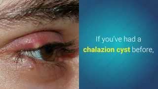 Chalazion Prevention  Tips to Prevent a Chalazion from Coming Back [upl. by Wilser527]