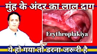 Is erythroplakia a cancer what are the symptoms of erythoplakia DrAmitkrDubey [upl. by Kaenel]