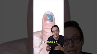 Hematoma Subungueal 💅😱 medicina medico curiosidades saude enfermeira enfermagem saúde [upl. by Osnofledi]