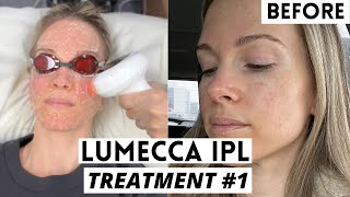 LUMECCA IPL  BEFORE amp AFTER  VLOG [upl. by Ettenotna]