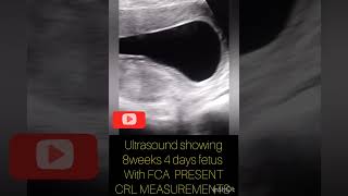 Ultrasound showing 8weeks fetusCRL measurementsyoutubeshortspregnancyviralshort babyindiausa [upl. by Piks]